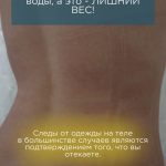 Следы от одежды на теле в большинстве случаев являются подтверждением того, что Вы отекаете.